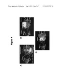 PANCREATIC CANCER TREATMENT diagram and image