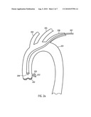 Cardiac Assist Device diagram and image