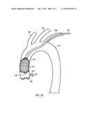 Cardiac Assist Device diagram and image