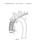 Cardiac Assist Device diagram and image