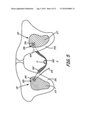 IMPLANTABLE DEVICES, TOOLS AND METHODS FOR ANATOMICAL SUPPORT diagram and image