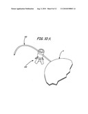 IMPLANTABLE DEVICES, TOOLS AND METHODS FOR ANATOMICAL SUPPORT diagram and image