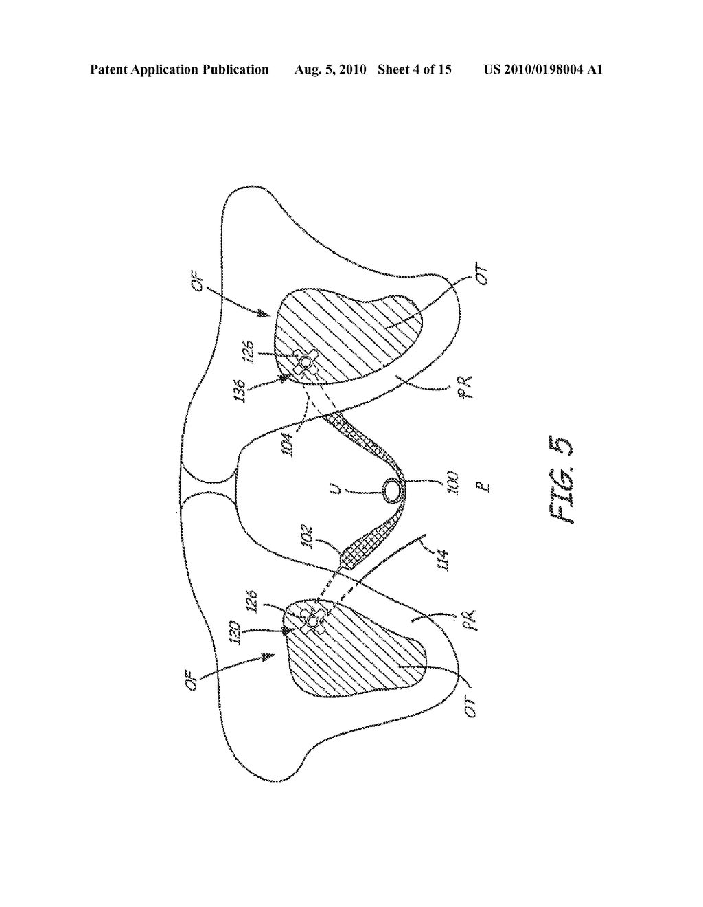 IMPLANTABLE ANATOMICAL SUPPORT - diagram, schematic, and image 05