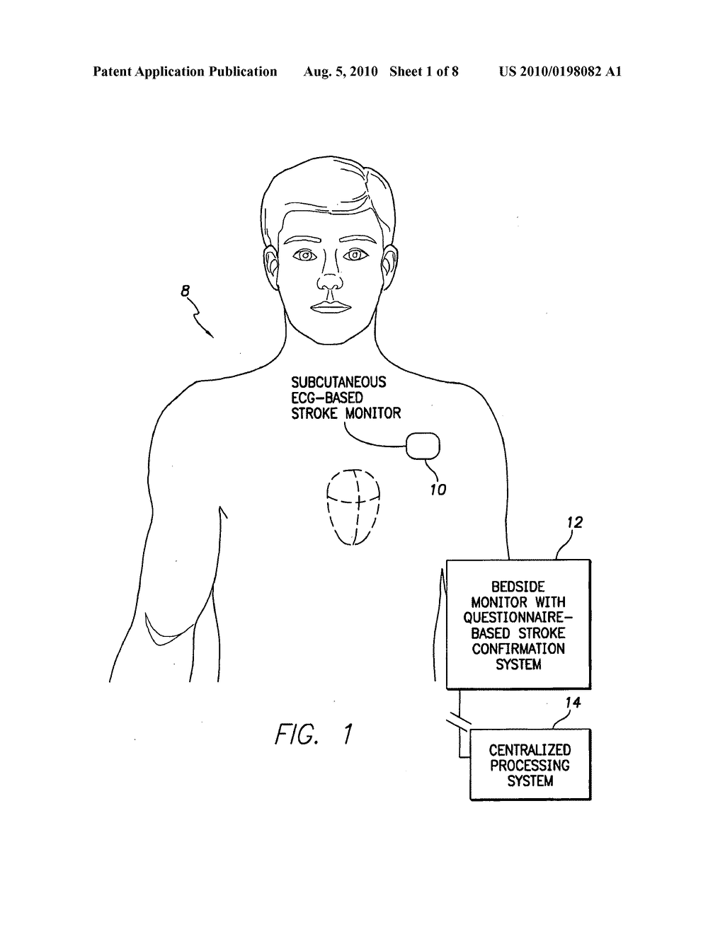 Systems and Methods for Use with an Implantable Medical Device for Detecting Stroke Based on Electrocardiac Signals - diagram, schematic, and image 02