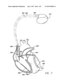 Systems and Methods for Use with an Implantable Medical Device for Detecting Stroke Based on Electrocardiac Signals diagram and image