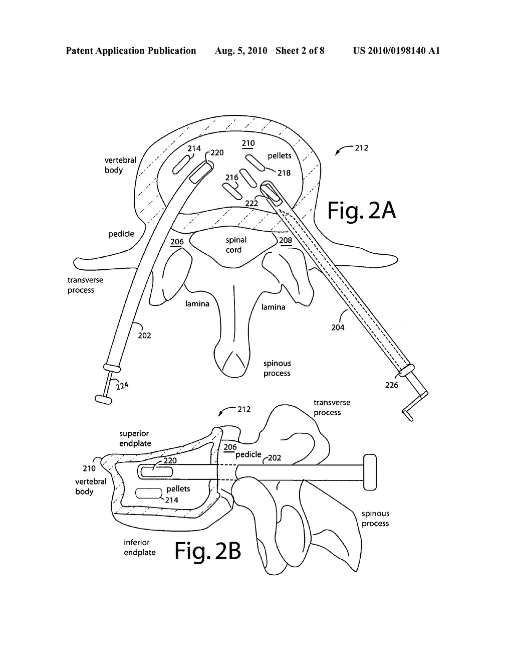 Percutaneous tools and bone pellets for vertebral body reconstruction - diagram, schematic, and image 03