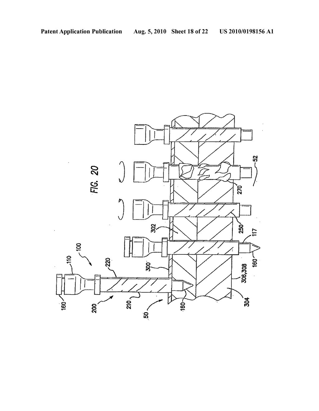 CANNULA WITH A DEPLOYABLE EXTERNAL THREAD - diagram, schematic, and image 19