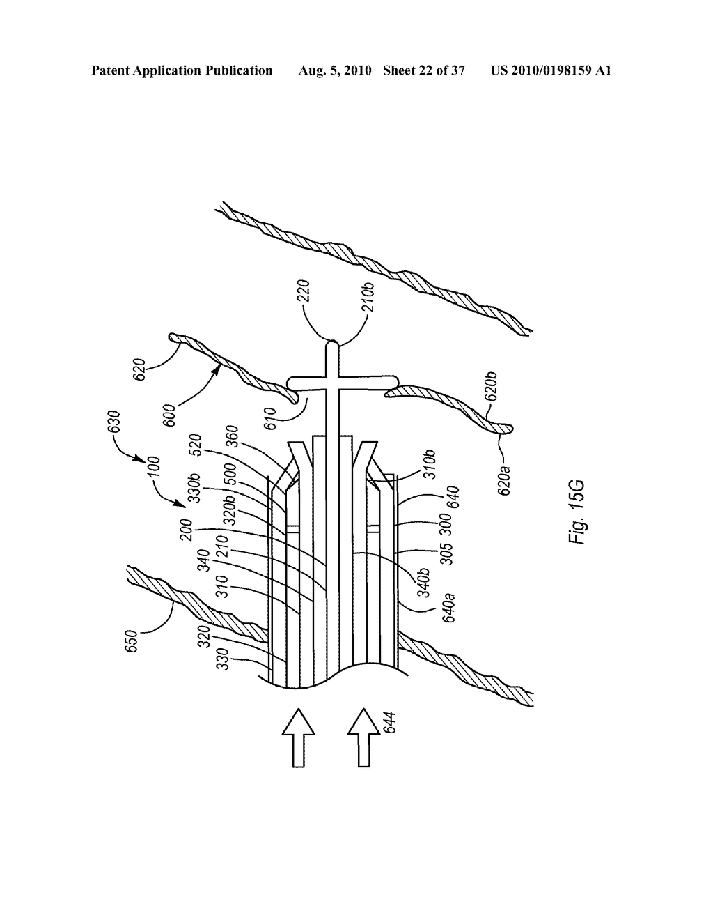 EXPANDABLE INTRODUCER SHEATH TO PRESERVE GUIDEWIRE ACCESS - diagram, schematic, and image 23