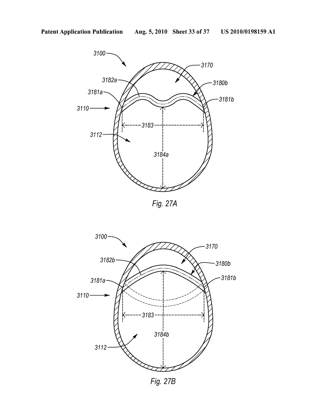 EXPANDABLE INTRODUCER SHEATH TO PRESERVE GUIDEWIRE ACCESS - diagram, schematic, and image 34