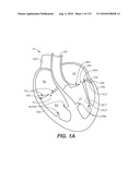 DIAGNOSTIC CATHETERS, GUIDE CATHETERS, VISUALIZATION DEVICES AND CHORD MANIPULATION DEVICES, AND RELATED KITS AND METHODS diagram and image