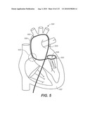 DIAGNOSTIC CATHETERS, GUIDE CATHETERS, VISUALIZATION DEVICES AND CHORD MANIPULATION DEVICES, AND RELATED KITS AND METHODS diagram and image