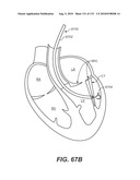 DIAGNOSTIC CATHETERS, GUIDE CATHETERS, VISUALIZATION DEVICES AND CHORD MANIPULATION DEVICES, AND RELATED KITS AND METHODS diagram and image