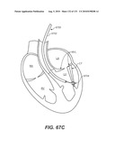 DIAGNOSTIC CATHETERS, GUIDE CATHETERS, VISUALIZATION DEVICES AND CHORD MANIPULATION DEVICES, AND RELATED KITS AND METHODS diagram and image