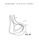 DIAGNOSTIC CATHETERS, GUIDE CATHETERS, VISUALIZATION DEVICES AND CHORD MANIPULATION DEVICES, AND RELATED KITS AND METHODS diagram and image