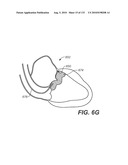 DIAGNOSTIC CATHETERS, GUIDE CATHETERS, VISUALIZATION DEVICES AND CHORD MANIPULATION DEVICES, AND RELATED KITS AND METHODS diagram and image