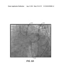 DIAGNOSTIC CATHETERS, GUIDE CATHETERS, VISUALIZATION DEVICES AND CHORD MANIPULATION DEVICES, AND RELATED KITS AND METHODS diagram and image