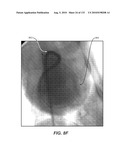 DIAGNOSTIC CATHETERS, GUIDE CATHETERS, VISUALIZATION DEVICES AND CHORD MANIPULATION DEVICES, AND RELATED KITS AND METHODS diagram and image