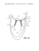 DIAGNOSTIC CATHETERS, GUIDE CATHETERS, VISUALIZATION DEVICES AND CHORD MANIPULATION DEVICES, AND RELATED KITS AND METHODS diagram and image