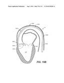 DIAGNOSTIC CATHETERS, GUIDE CATHETERS, VISUALIZATION DEVICES AND CHORD MANIPULATION DEVICES, AND RELATED KITS AND METHODS diagram and image