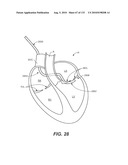 DIAGNOSTIC CATHETERS, GUIDE CATHETERS, VISUALIZATION DEVICES AND CHORD MANIPULATION DEVICES, AND RELATED KITS AND METHODS diagram and image