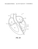 DIAGNOSTIC CATHETERS, GUIDE CATHETERS, VISUALIZATION DEVICES AND CHORD MANIPULATION DEVICES, AND RELATED KITS AND METHODS diagram and image