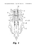 Crosslink Interconnection of Bone Attachment Devices diagram and image