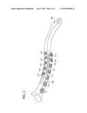 Biplanar Fracture Fixation diagram and image