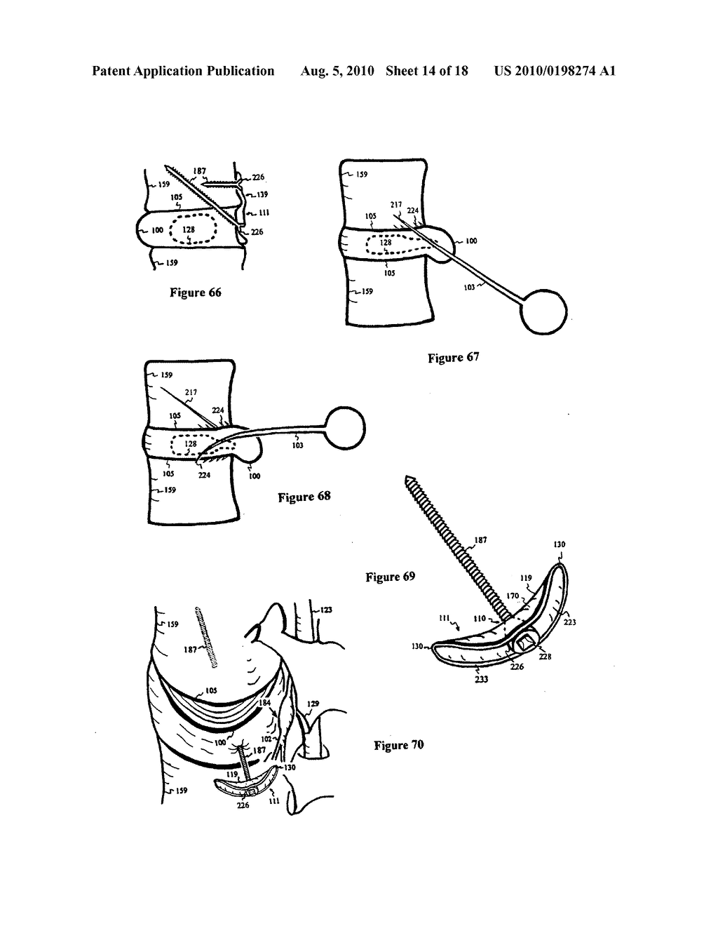 Intervertebral disc inserting device - diagram, schematic, and image 15