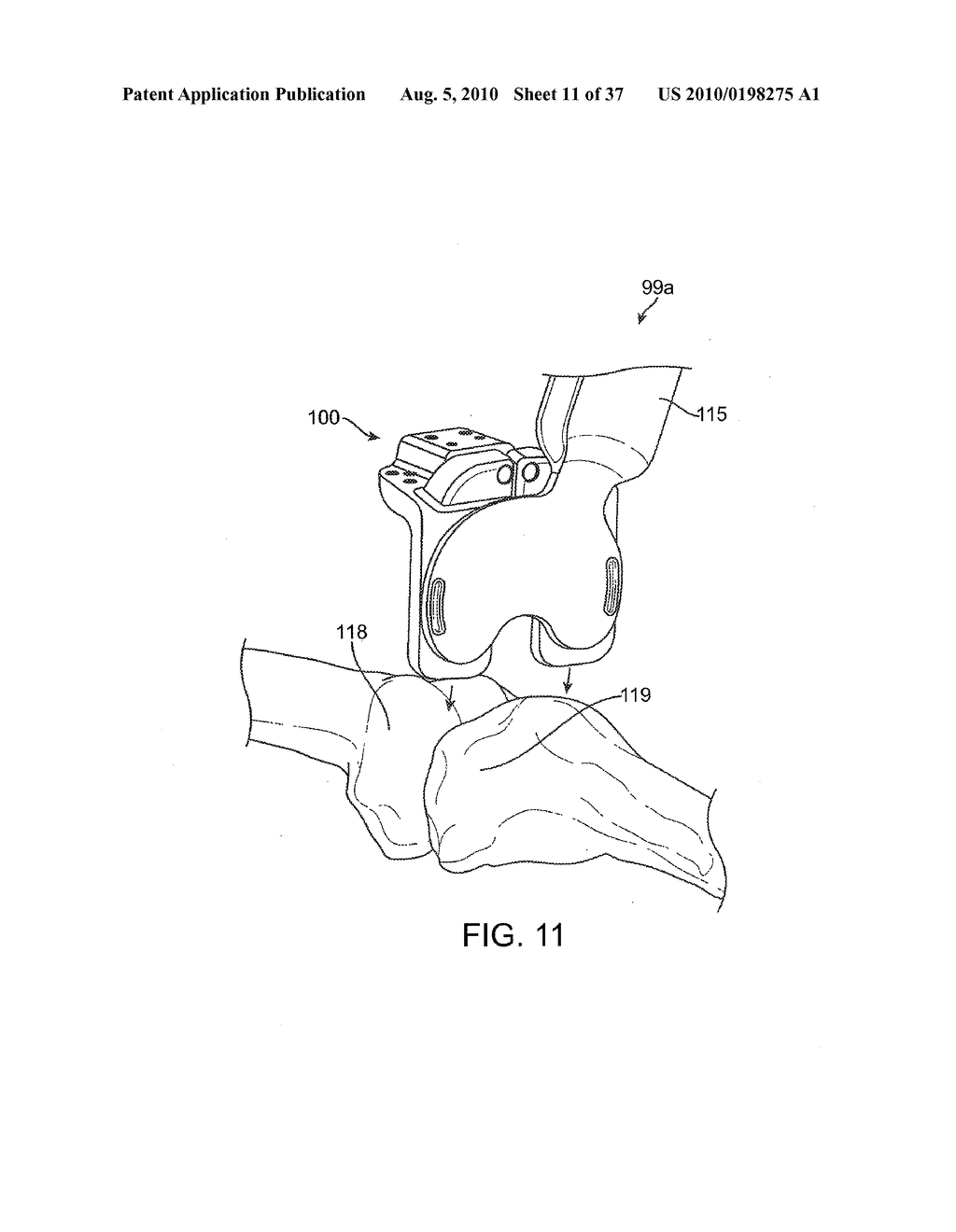 FORCE SENSING DISTAL FEMORAL ALIGNMENT SYSTEM AND METHOD OF USE - diagram, schematic, and image 12