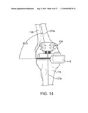 FORCE SENSING DISTAL FEMORAL ALIGNMENT SYSTEM AND METHOD OF USE diagram and image