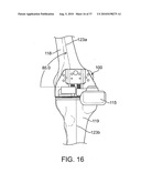 FORCE SENSING DISTAL FEMORAL ALIGNMENT SYSTEM AND METHOD OF USE diagram and image