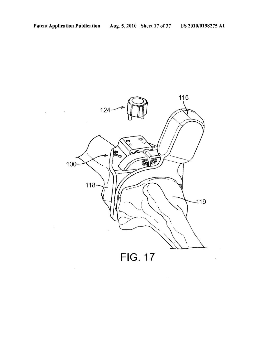 FORCE SENSING DISTAL FEMORAL ALIGNMENT SYSTEM AND METHOD OF USE - diagram, schematic, and image 18