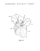 FORCE SENSING DISTAL FEMORAL ALIGNMENT SYSTEM AND METHOD OF USE diagram and image