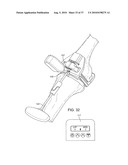 FORCE SENSING DISTAL FEMORAL ALIGNMENT SYSTEM AND METHOD OF USE diagram and image