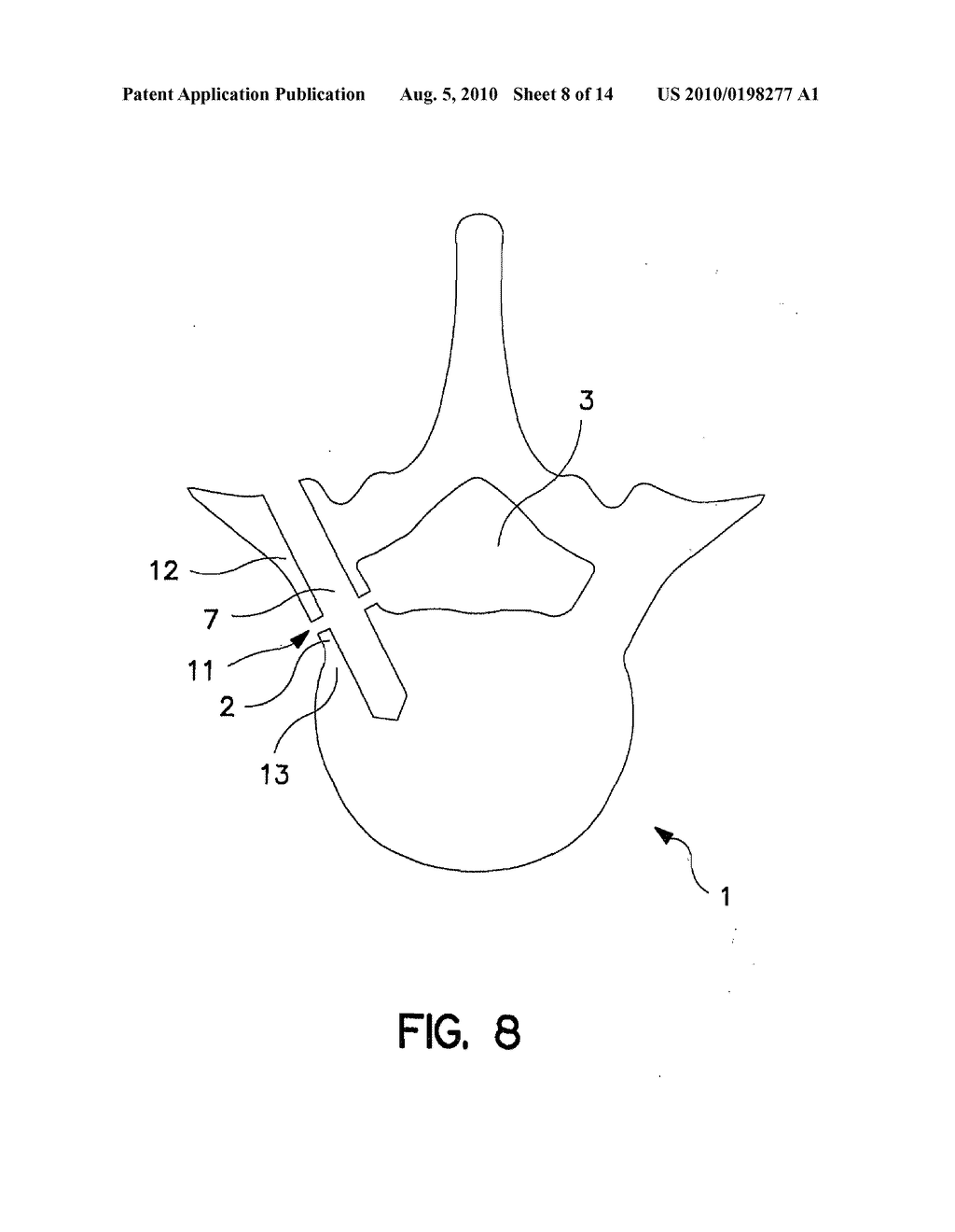 PERCUTANEOUS TECHNIQUE AND IMPLANT FOR EXPANDING THE SPINAL CANAL - diagram, schematic, and image 09