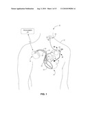 DETECTING AND TREATING ELECTROMECHANICAL DISSOCIATION OF THE HEART diagram and image