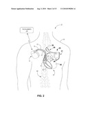 DETECTING AND TREATING ELECTROMECHANICAL DISSOCIATION OF THE HEART diagram and image