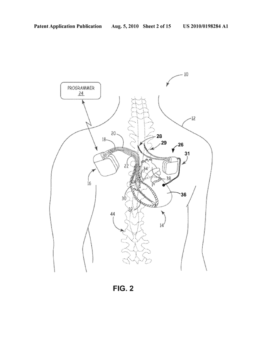 DETECTING AND TREATING ELECTROMECHANICAL DISSOCIATION OF THE HEART - diagram, schematic, and image 03