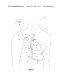 DETECTING AND TREATING ELECTROMECHANICAL DISSOCIATION OF THE HEART diagram and image