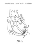 DISTANCE-BASED ANALYSIS OF RETURN CYCLES FOR TACHYCARDIA DISCRIMINATION diagram and image