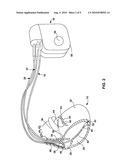 EVALUATING ELECTRODE CONFIGURATIONS FOR DELIVERING CARDIAC PACING THERAPY diagram and image