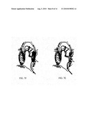 ELECTRICAL STIMULATION IN THE MIDDLE EAR FOR TREATMENT OF HEARING RELATED DISORDERS diagram and image