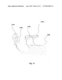 ELECTRICAL STIMULATION IN THE MIDDLE EAR FOR TREATMENT OF HEARING RELATED DISORDERS diagram and image