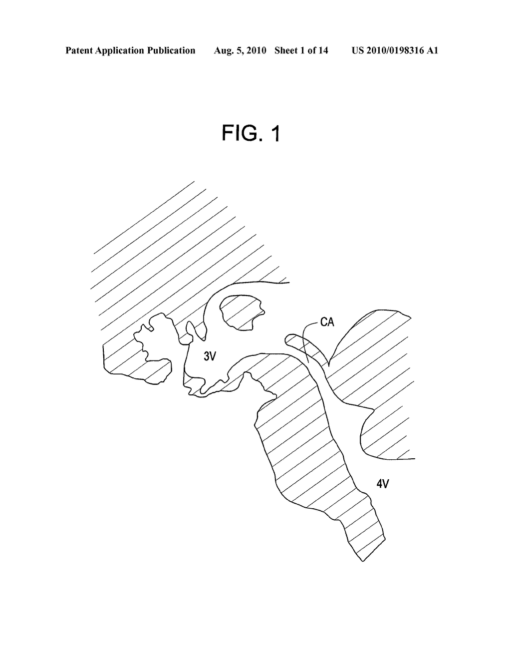 Intracranial Red Light Treatment Device For Chronic Pain - diagram, schematic, and image 02