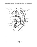 HEARING AID WITH AN ELONGATE MEMBER diagram and image