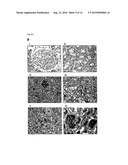 HYPOXIA-INDUCIBLE PROTEIN 2 (HIG 2), A DIAGNOSTIC MARKER FOR CLEAR CELL RENAL CELL CARCINOMA diagram and image