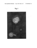 TREATMENT FOR LEUKEMIA AND IDIOPATHIC APLASTIC ANEMIA diagram and image