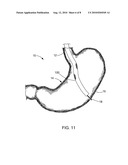 EXPANDABLE PORT FOR ACCESSING A BODILY OPENING diagram and image