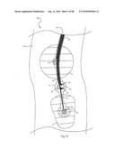 LOW PROFILE ELECTRODE ASSEMBLY diagram and image