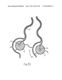 LOW PROFILE ELECTRODE ASSEMBLY diagram and image